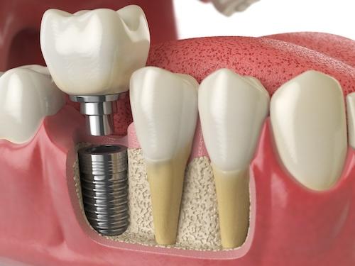 image of a dental implant in columbia md