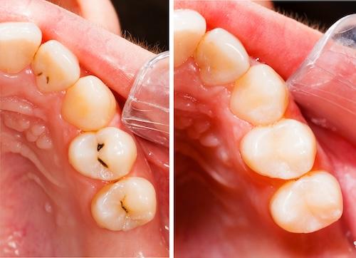 Teeth before and after composite filling at Pineview Dental in Columbia, MD