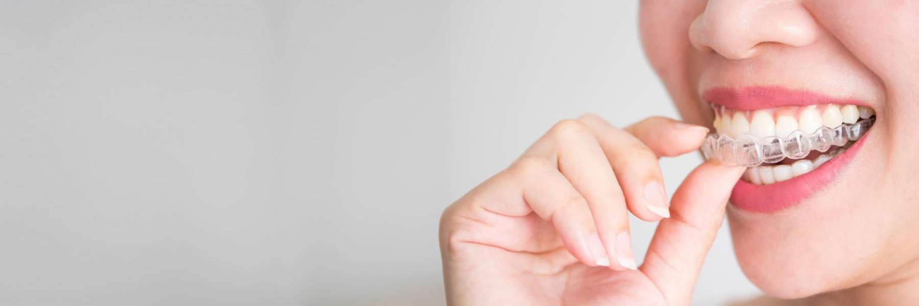 Invisalign® Clear Aligners | Dentist