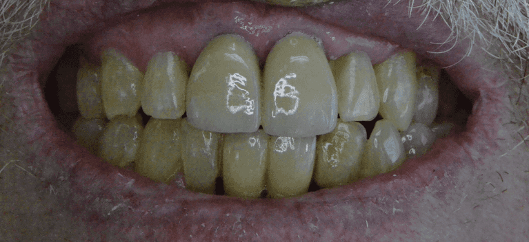 Smile-Restored-After-Image