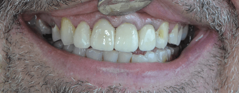 Smile-Restored-with-Custom-Crowns-After-Image