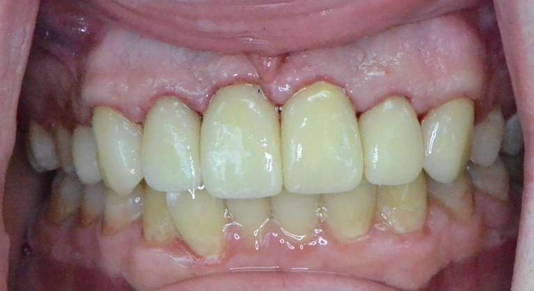 Smile-Rebuilt-with-Crowns-and-Esthetic-Care-After-Image