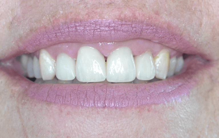 From-Decay-to-Beautiful-After-Image