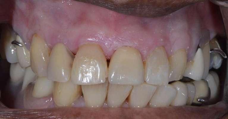 Stronger-More-Beautiful-with-Crowns-After-Image