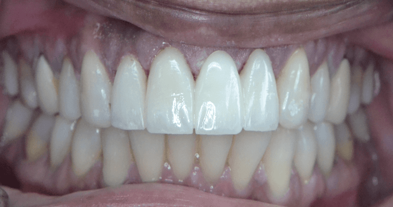 After Esthetic Dentistry That Enhances Natural Beauty