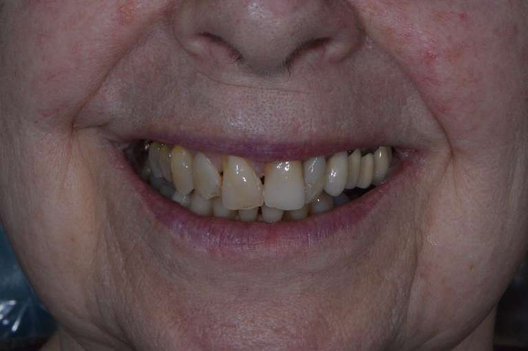 Comprehensive-Smile-Rehabilitation-After-Image