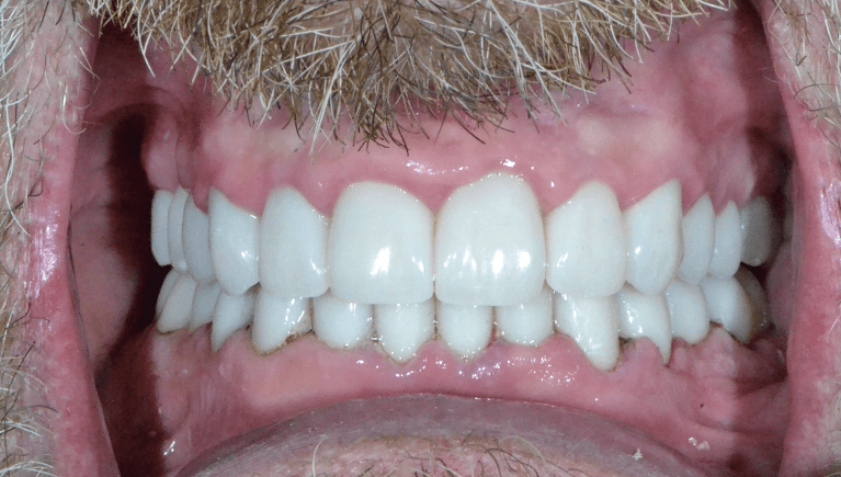 After improving the appearance of a severely discolored teeth