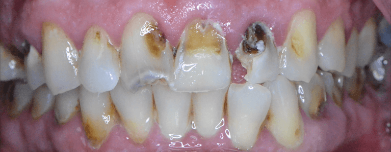 Smile-Restored-with-Custom-Crowns-Before-Image