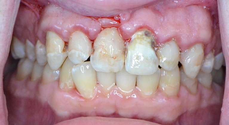 Smile-Rebuilt-with-Crowns-and-Esthetic-Care-Before-Image