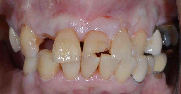 Stronger-More-Beautiful-with-Crowns-Before-Image