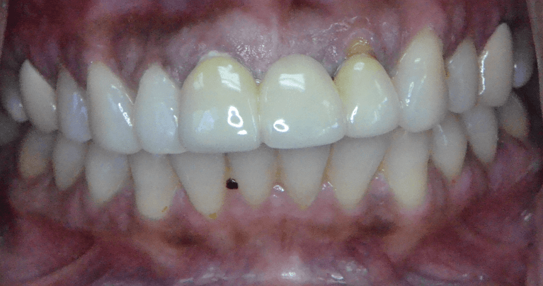 Before Esthetic Dentistry That Enhances Natural Beauty