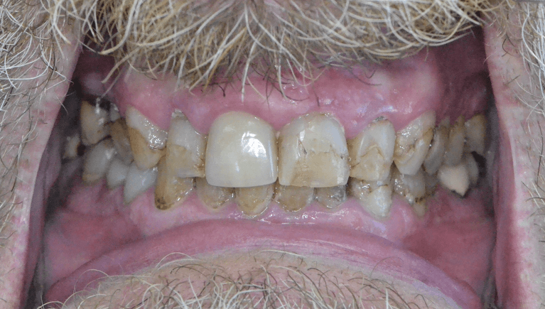 Before improving the appearance of a severely discolored teeth