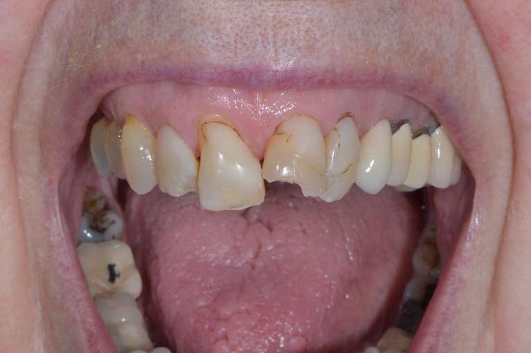 Comprehensive-Smile-Rehabilitation-Before-Image
