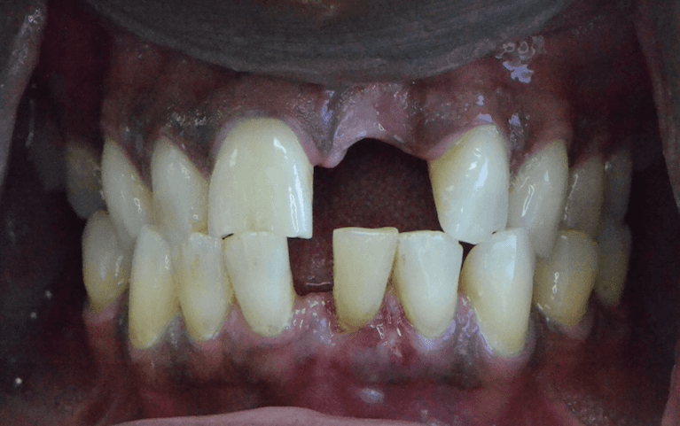 Restoring-What-s-Missing-Before-Image